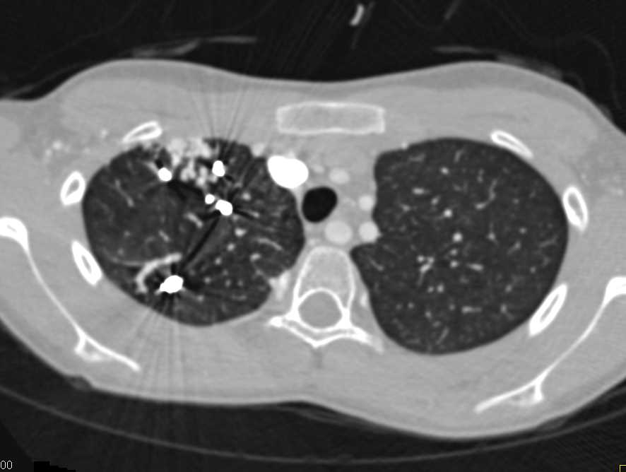 Multiple Pulmonary Arteriovenous Malformations (PAVMs) with Prior Embolizations - CTisus CT Scan