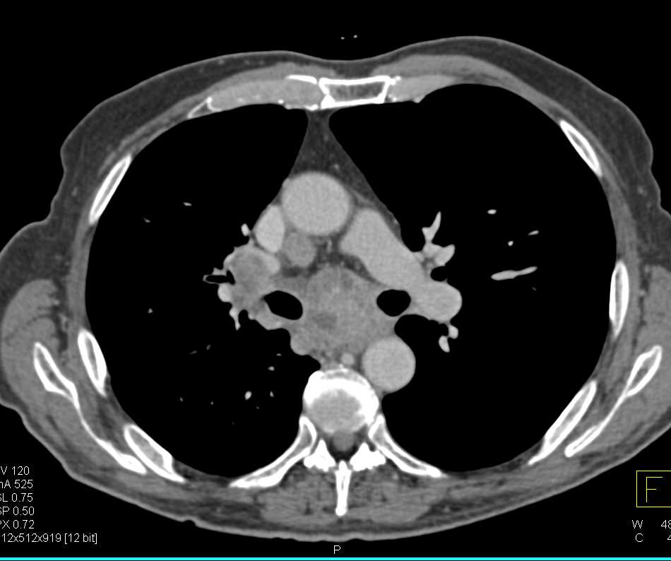 Metastatic renal Cell Carcinoma to Mediastinum, Lung and Adrenals - CTisus CT Scan