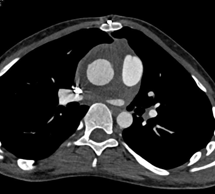 Aortic Root Repair with Post-Op Changes - CTisus CT Scan