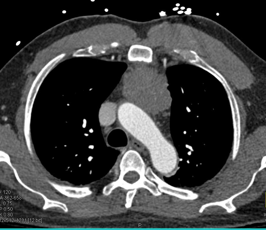 Thymoma - CTisus CT Scan