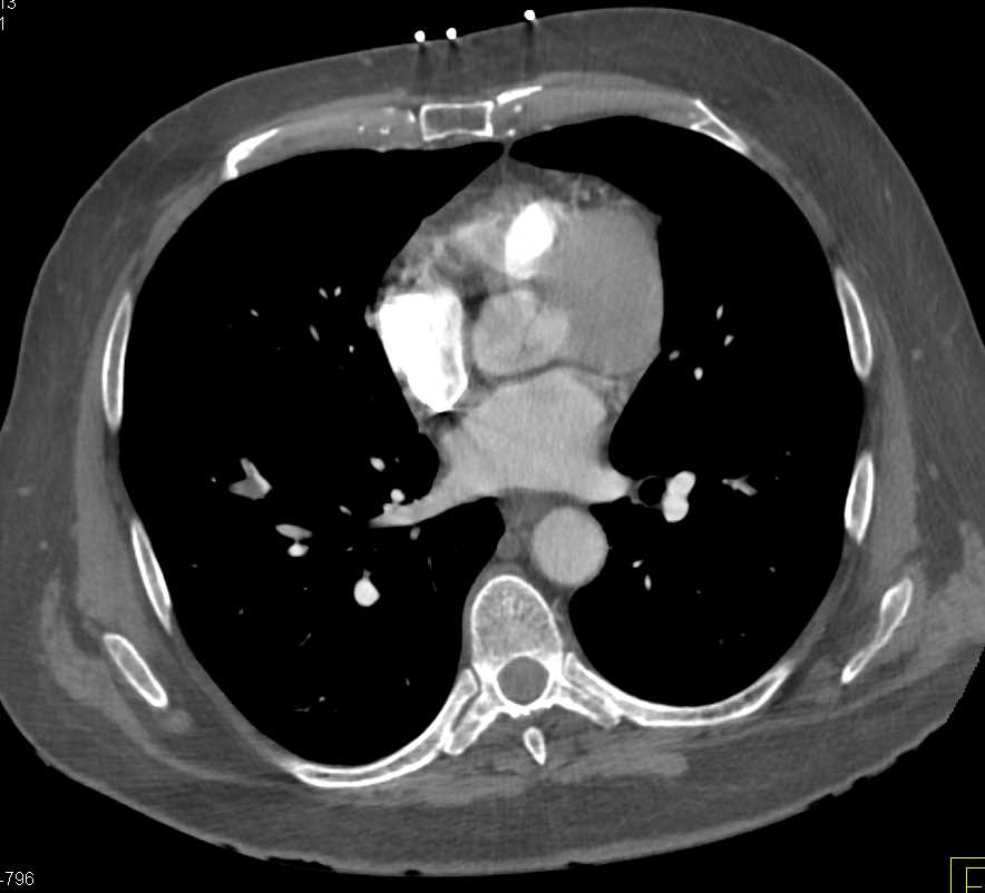 Pulmonary Embolism Right Lower Lung - CTisus CT Scan