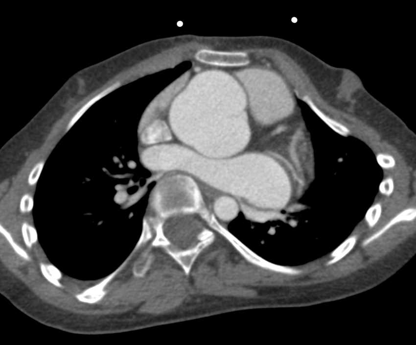 Markedly Dilated Root and Sinus of Valsalva in Marfan Syndrome. - CTisus CT Scan