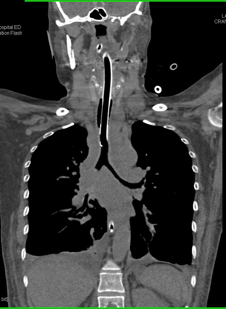 3D of Airway with Stent and Infiltration Around the Trachea and Mainstem Bronchi - CTisus CT Scan