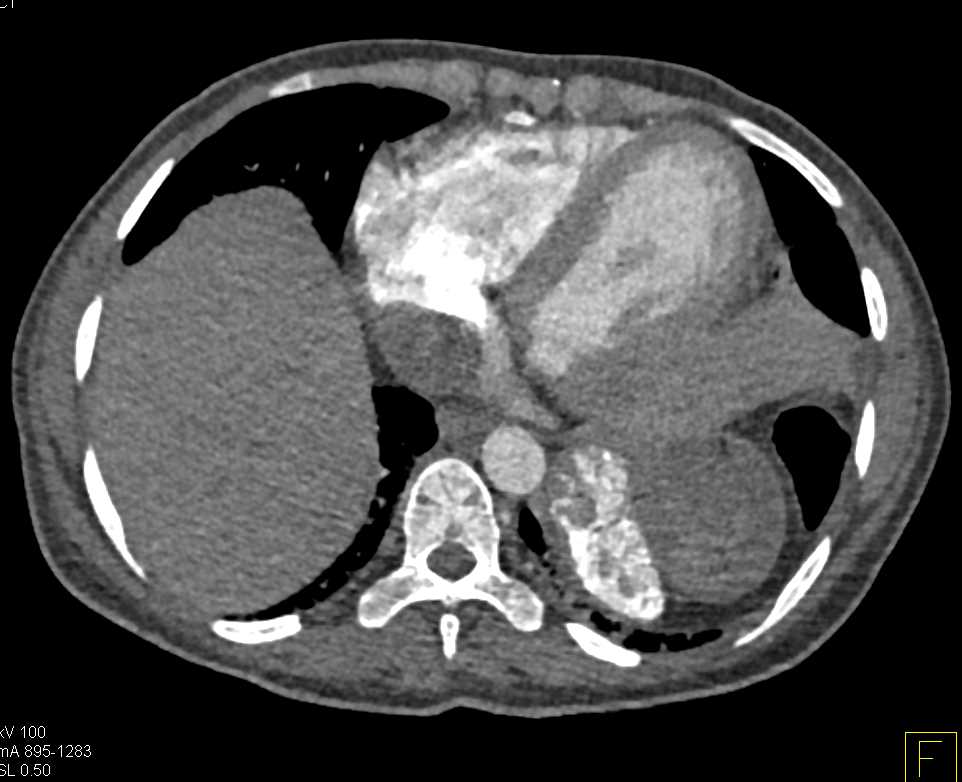 Prior Contrast Extravasation - CTisus CT Scan