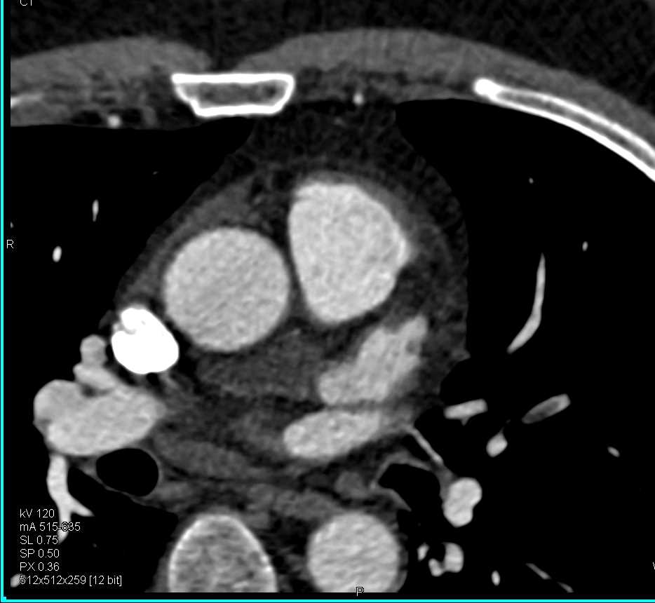 Pulmonary Embolism Right Lower Lobe Pulmonary Artery and Pseudo-Dissection Aortic Root - CTisus CT Scan