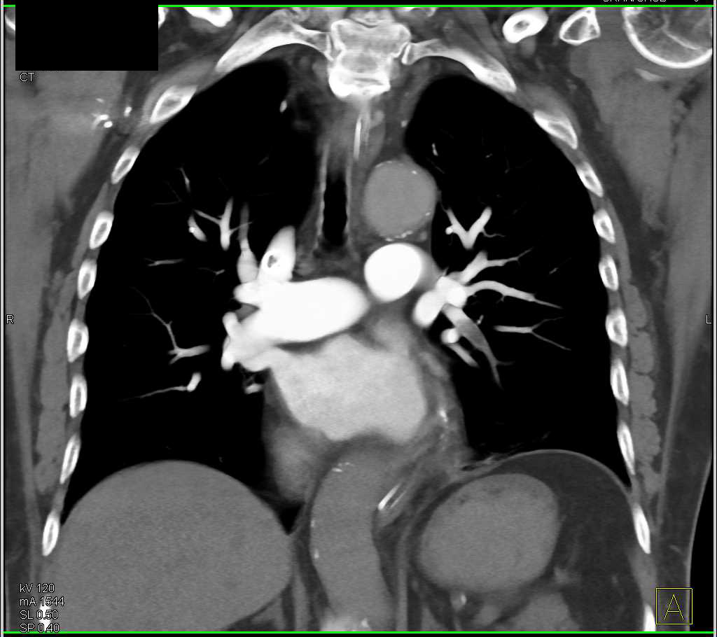 case study of patient with pulmonary embolism