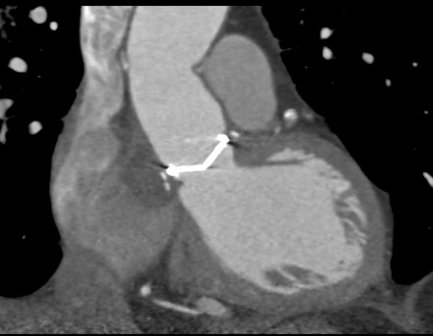 CTA with 3D of Aortic Valve Replacement (AVR) - CTisus CT Scan