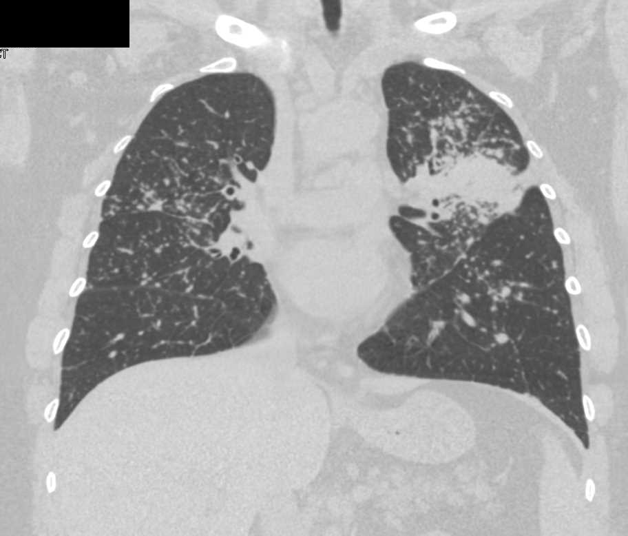 Miliary Tuberculosis (TB) with Tree in Bud Appearance - CTisus CT Scan