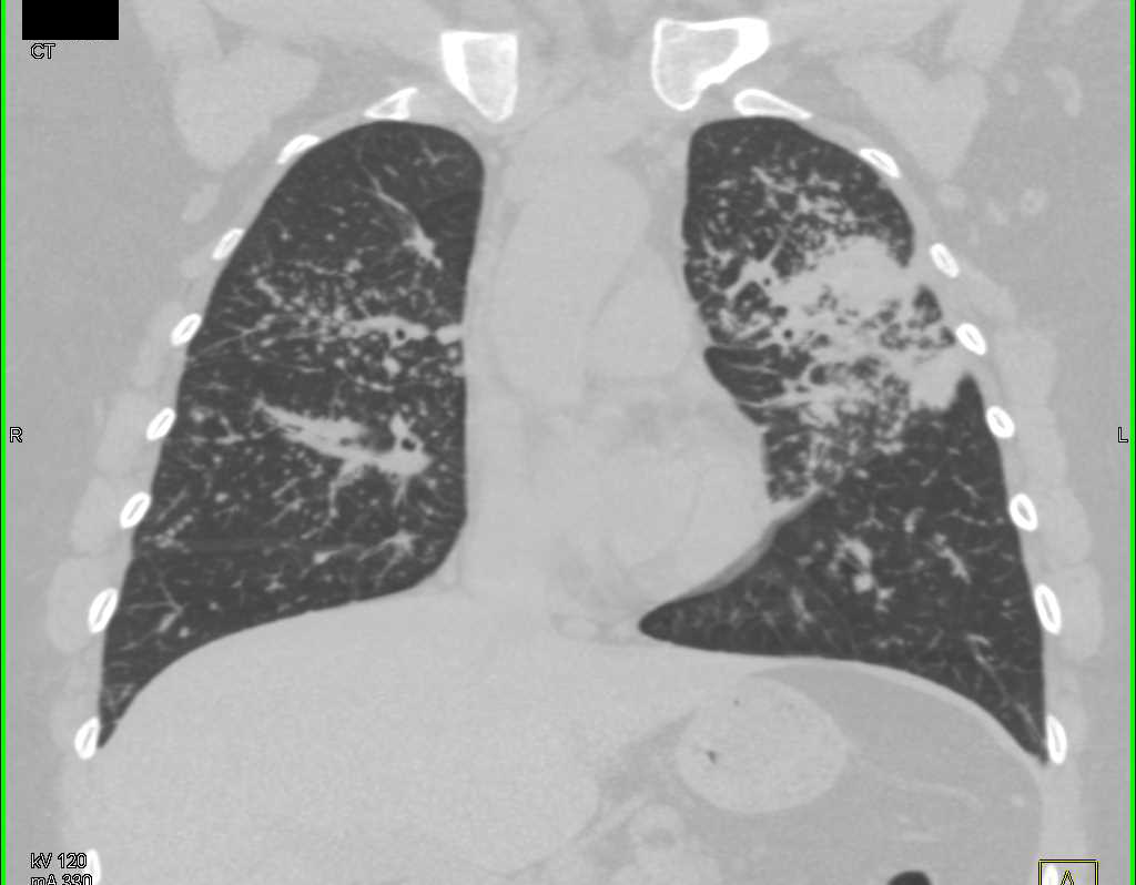 Miliary Tuberculosis (TB) with Tree in Bud Appearance - Chest Case Studies - CTisus CT Scanning