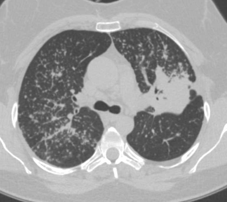 Miliary Tuberculosis (TB) with Tree in Bud Appearance - Chest Case