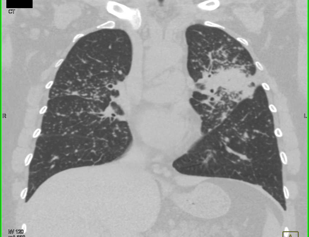 Miliary Tuberculosis (TB) with Tree in Bud Appearance - Chest Case