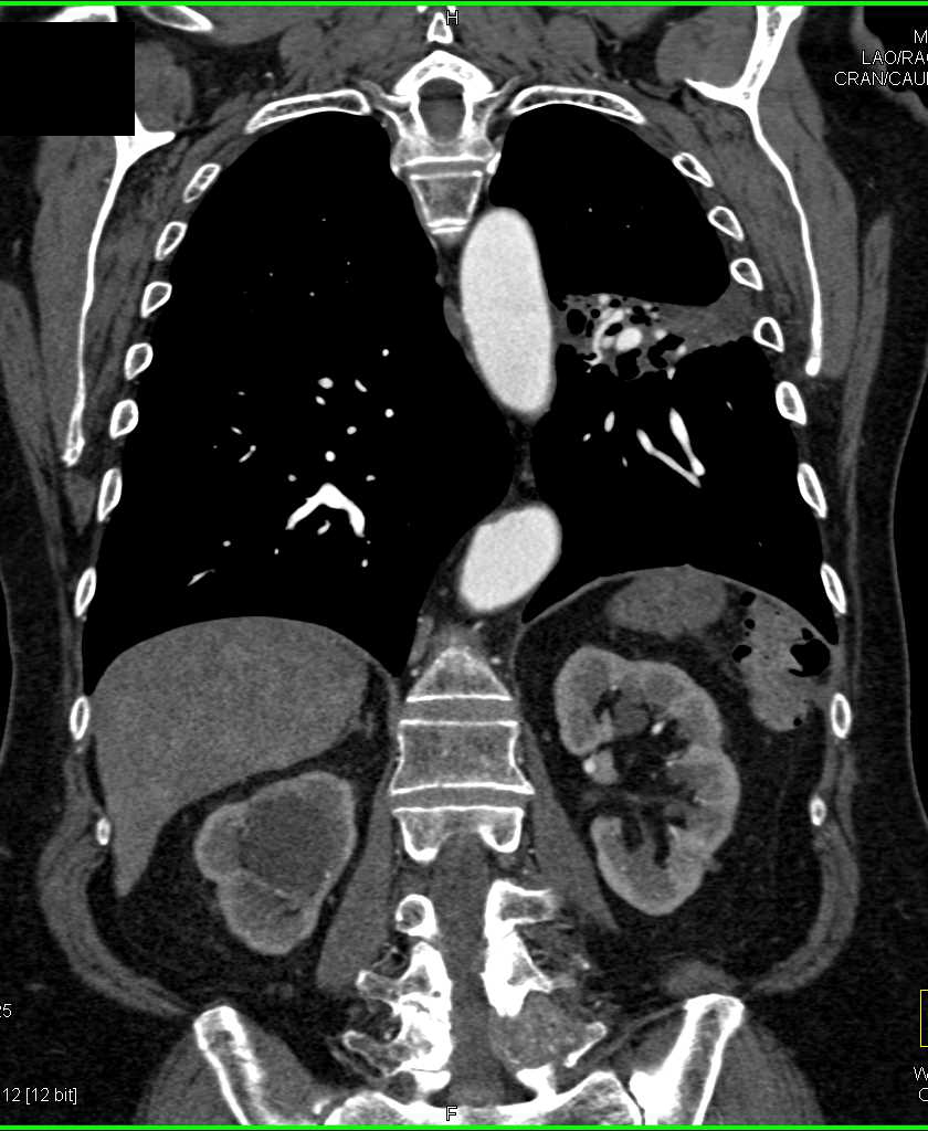 Lung Cancer with Liver Metastases - CTisus CT Scan