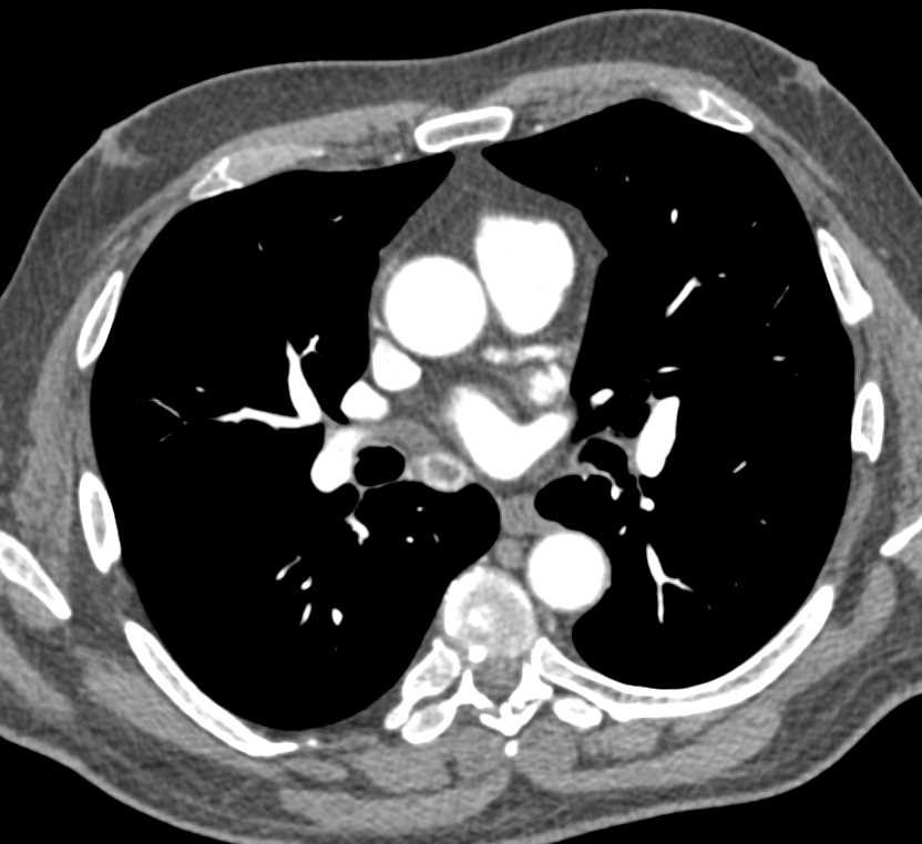 Recurrent Renal Cell Carcinoma to Mediastinal Nodes - CTisus CT Scan