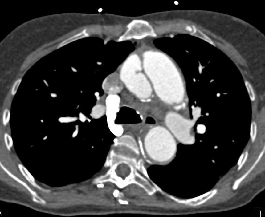 Type A Dissection Extends into the Branch Vessels off the Arch - CTisus CT Scan