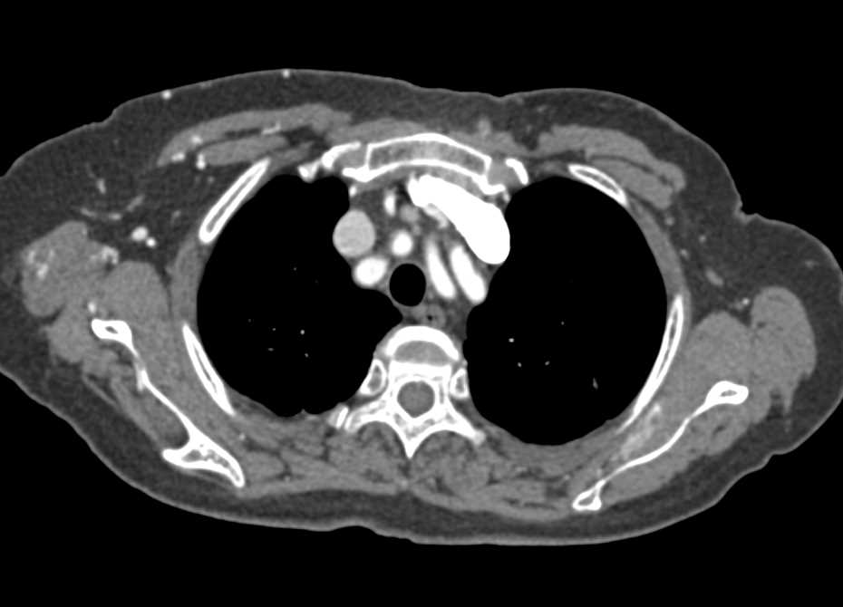 Vascular Muscle Metastases from Renal Cell Carcinoma - CTisus CT Scan