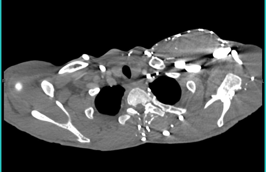 Superior Vena Cava (SVC) Stenosis and Collaterals Left Chest Wall - CTisus CT Scan