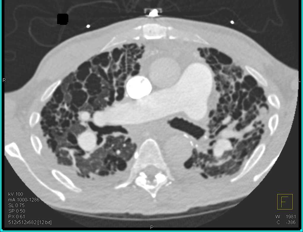 Invasive Pulmonary Aspergillosis (Left Upper Lung) in a Patient with Interstitial Lung Disease (ILD) - CTisus CT Scan