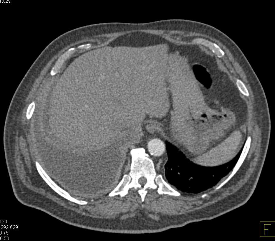 Implants on Right Pleural Surface - CTisus CT Scan