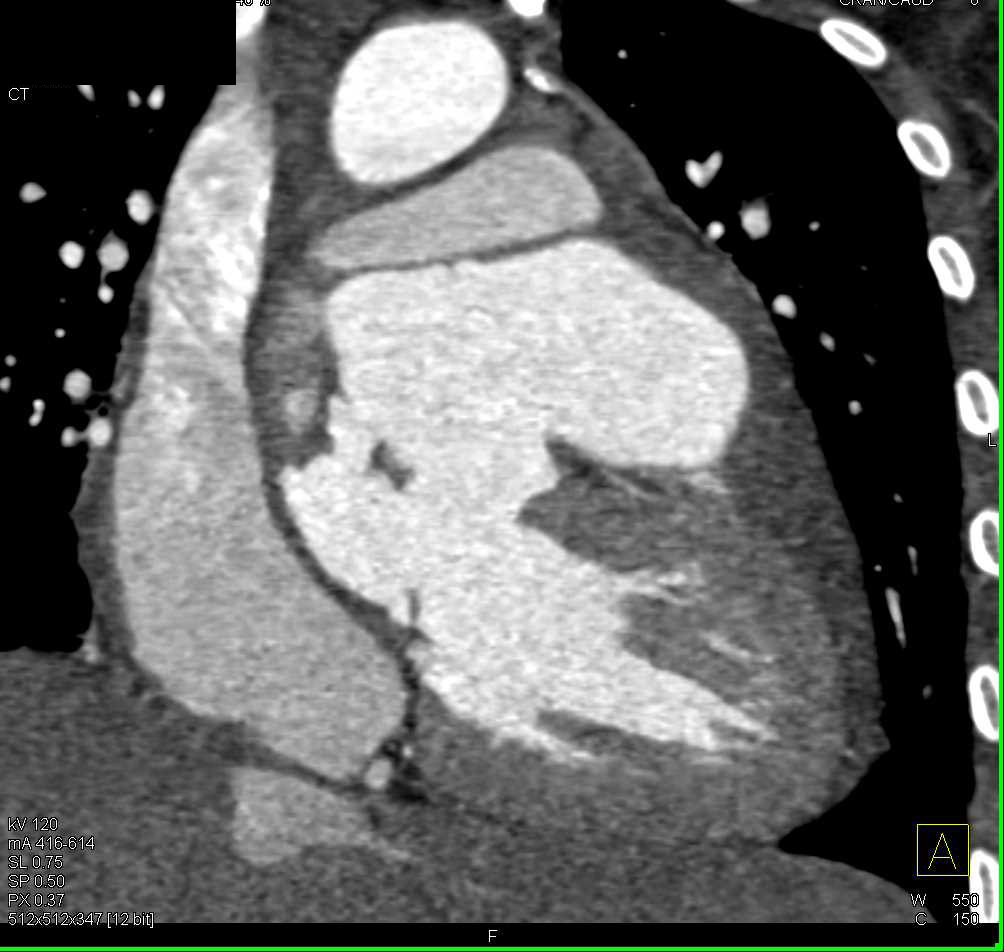 Endoleak Following Repair of Type A Dissection - CTisus CT Scan