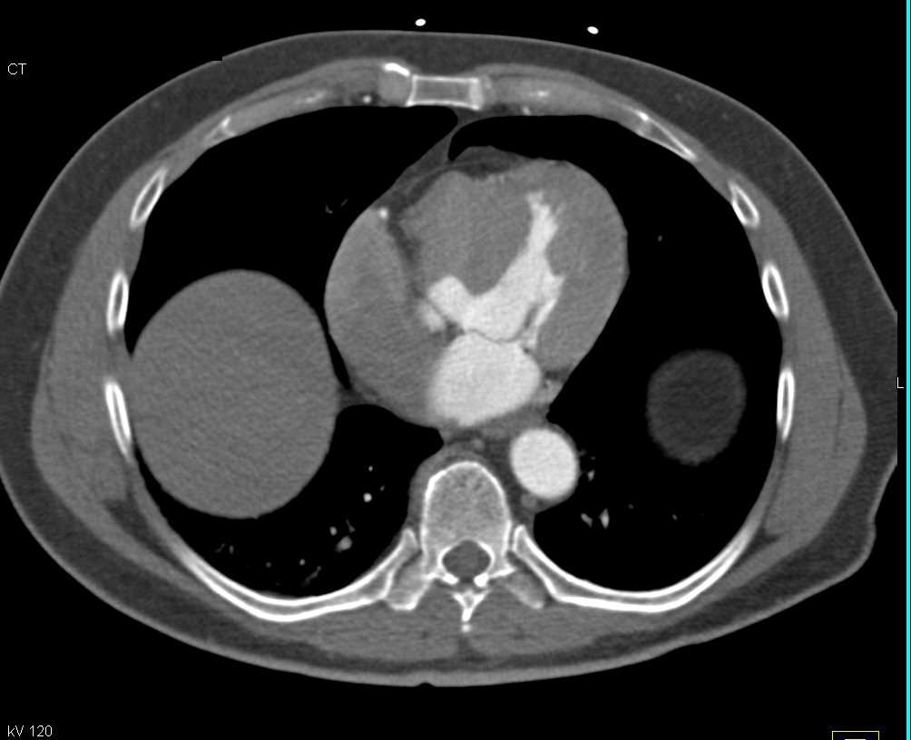 Hypertrophy Left Ventricle with Thickened Wall - CTisus CT Scan