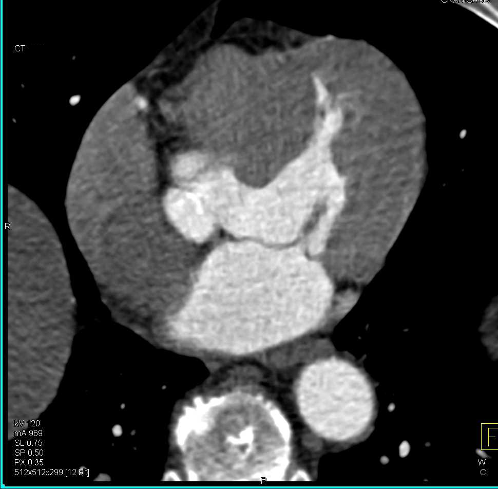Hypertrophy Left Ventricle with Thickened Wall - Chest Case Studies