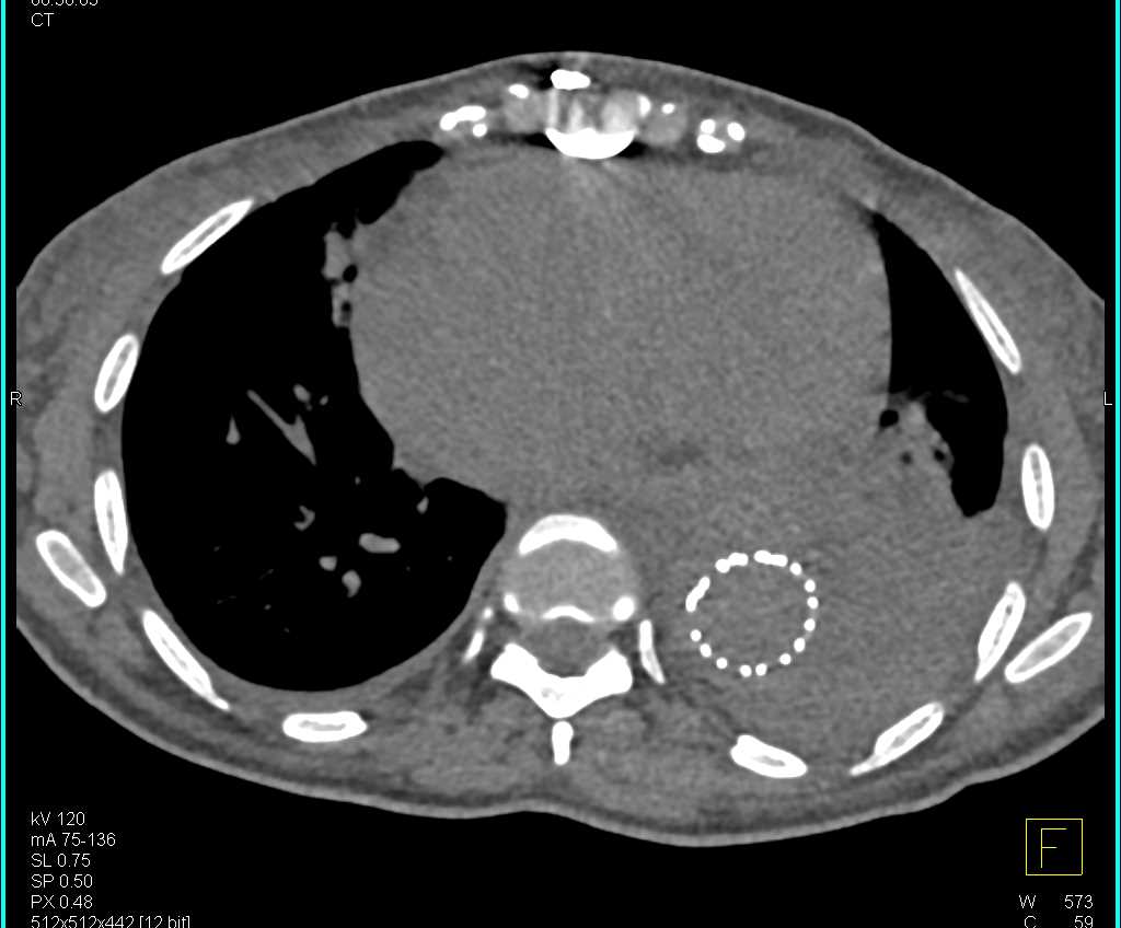 Outpouchings At Upper Margin Endovascular Stent Repair - CTisus CT Scan