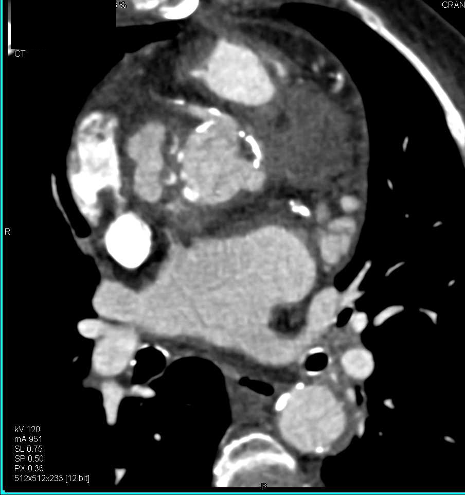 Pseudoaneurysm Aortic Root - CTisus CT Scan