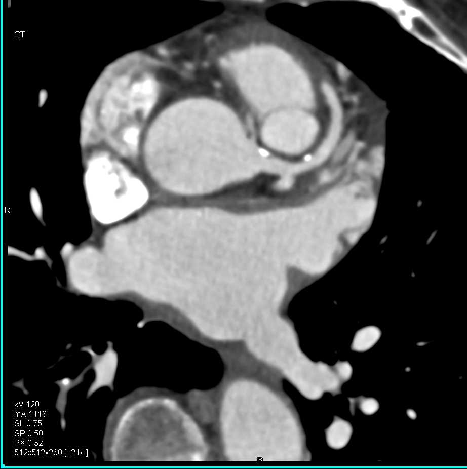 Multiple Bilateral Pulmonary Embolism - CTisus CT Scan