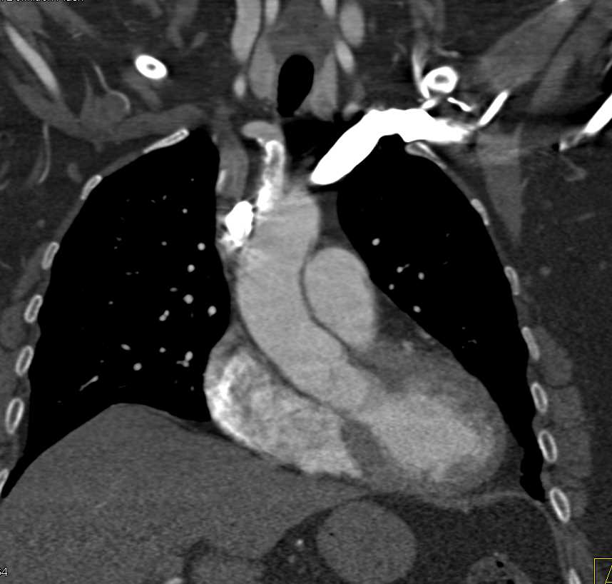 Variant Anatomy Left Innominate Vein - CTisus CT Scan