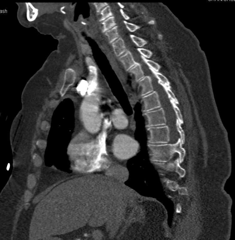 Unusual Course for Left Innominate Vein - CTisus CT Scan