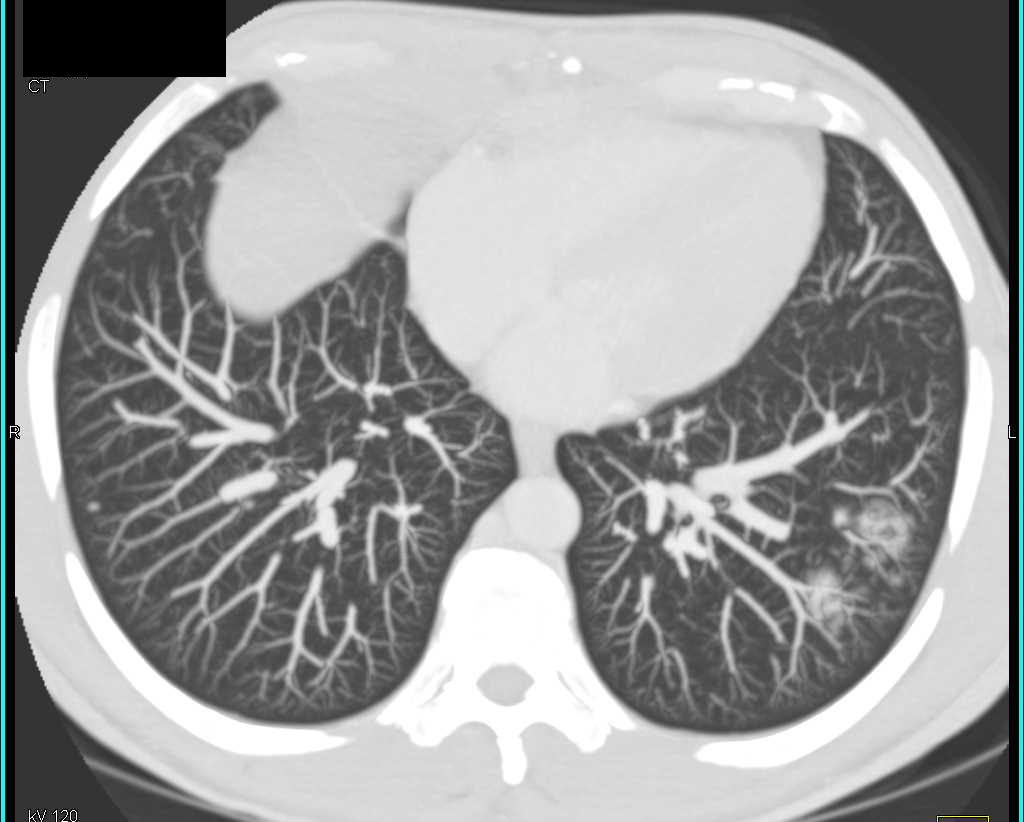 Multiple Metastatic Nodules from Pancreatic Cancer - CTisus CT Scan