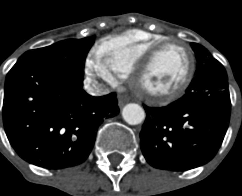 Pulmonary Embolism Right Lower Lobe Pulmonary Artery - CTisus CT Scan