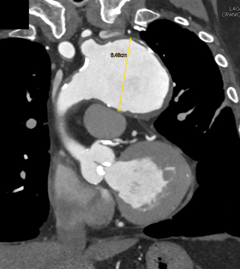 Aneurysm of Aortic Arch - CTisus CT Scan