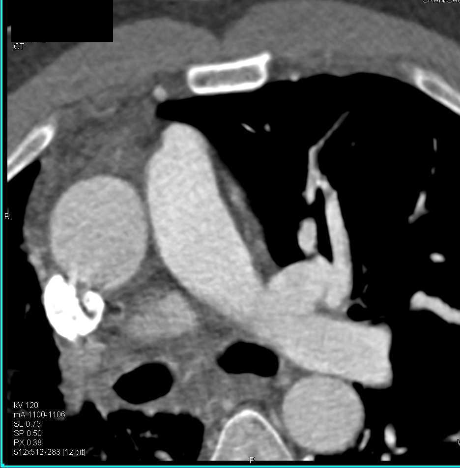 Prominent Bronchial Arteries - CTisus CT Scan