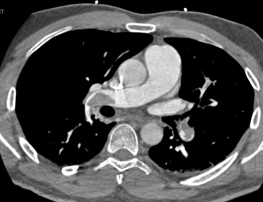 Multiple Bilateral Pulmonary Embolism - CTisus CT Scan