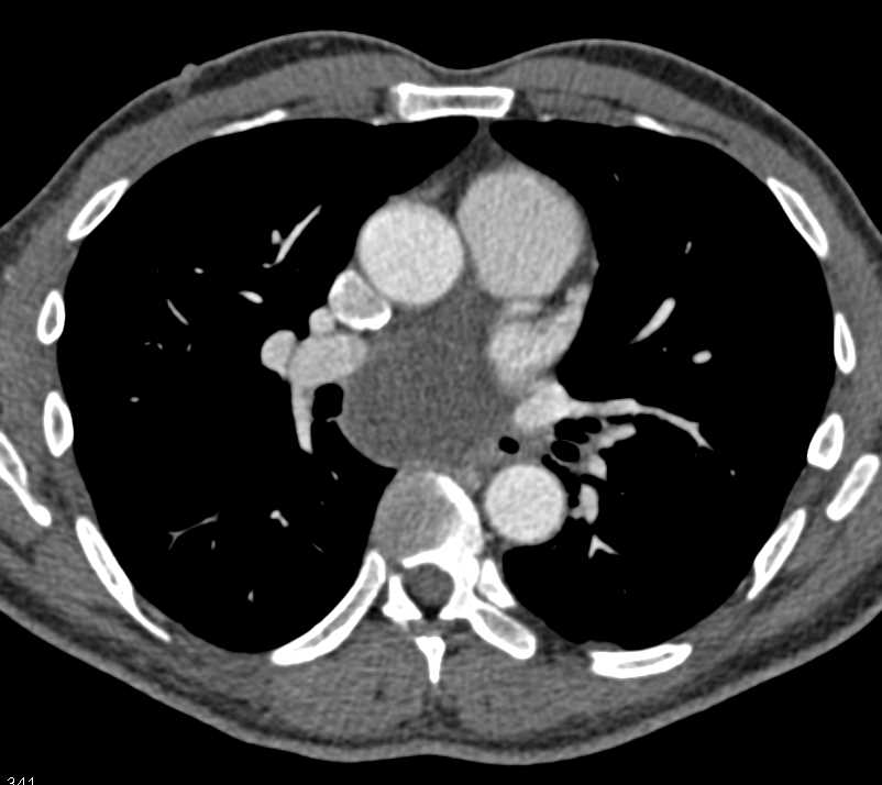 High Density Bronchogenic Cyst - Chest Case Studies - CTisus CT Scanning