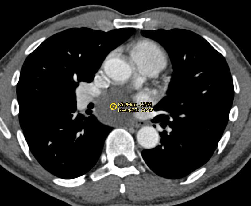 High Density Bronchogenic Cyst - CTisus CT Scan