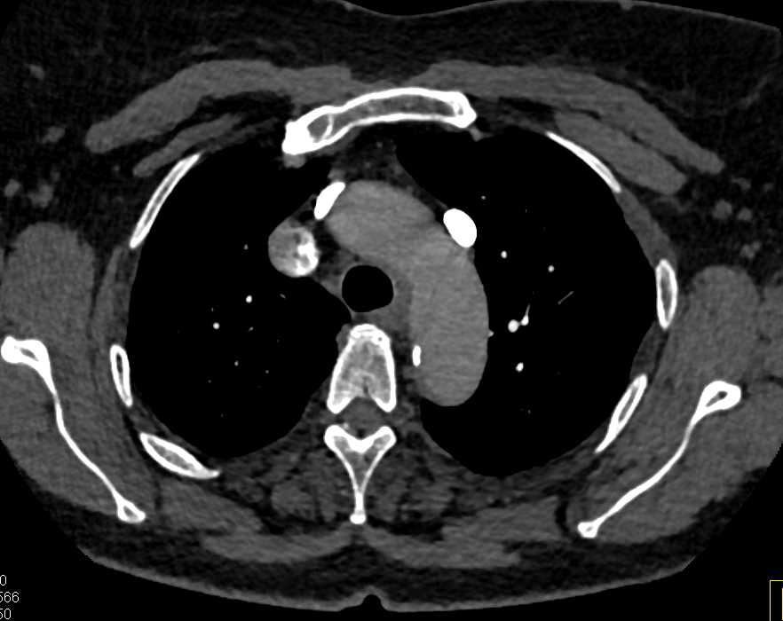Persistent Left superior vena cava (SVC) With Drainage to the Coronary Sinus - CTisus CT Scan