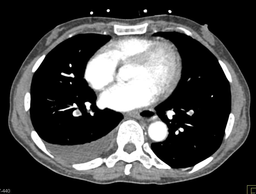 Bilateral Pulmonary Embolism - CTisus CT Scan