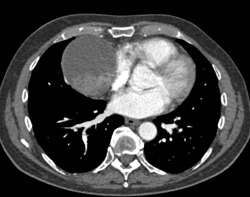 Fluid-Fluid Level in a Pericardial Cyst - CTisus CT Scan