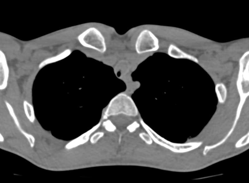 Tracheal Stenosis due to Inflammatory Stricture - CTisus CT Scan