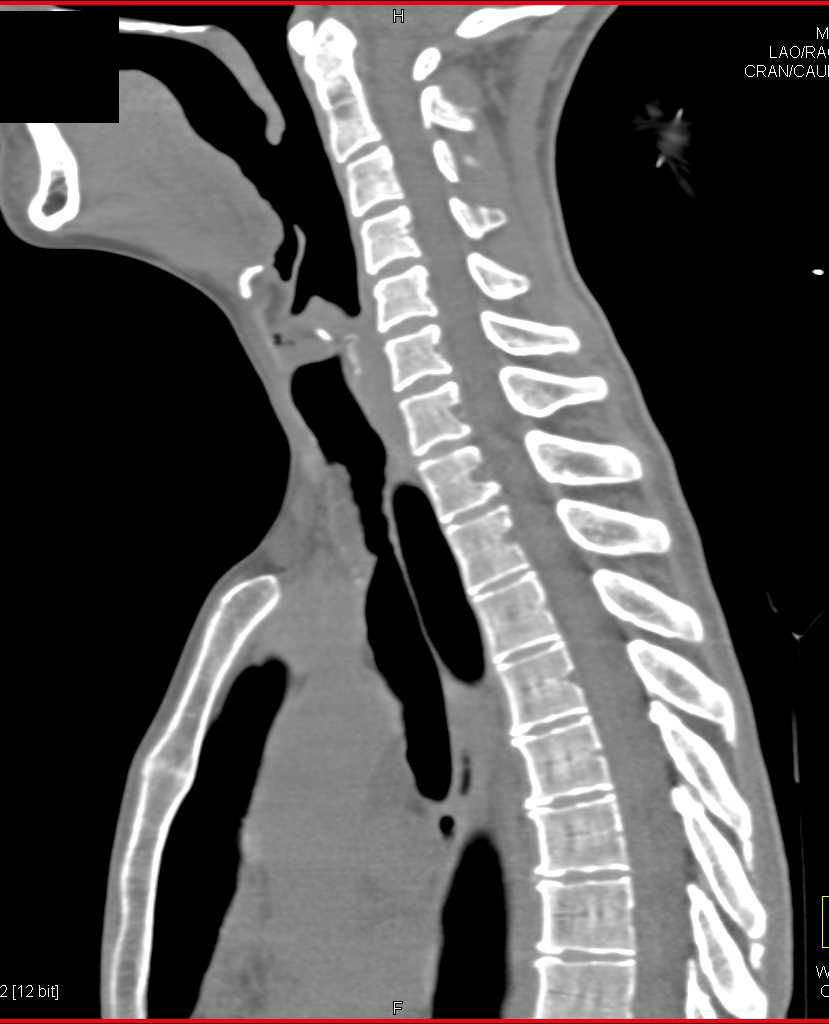 Tracheal Stenosis due to Inflammatory Stricture - CTisus CT Scan