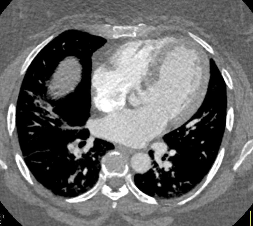 Multiple Pulmonary Embolism Best Seen in Right Lower Lobe - CTisus CT Scan