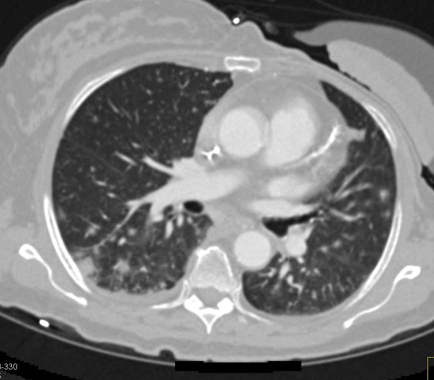 Septic Emboli - CTisus CT Scan