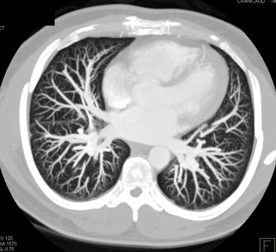 Pulmonary Arteriovenous Malformation (PAVM) in Left Lower Lung with Prior Embolization Coil - CTisus CT Scan