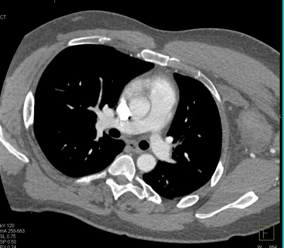 Hematoma Left Axillary Zone - CTisus CT Scan