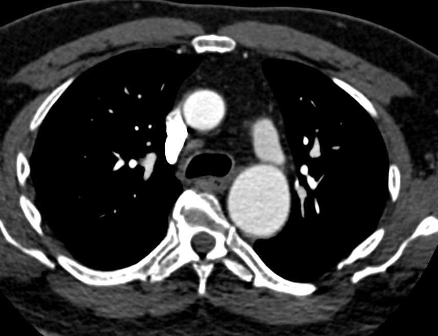 Prior Coarctation of the Aorta - CTisus CT Scan