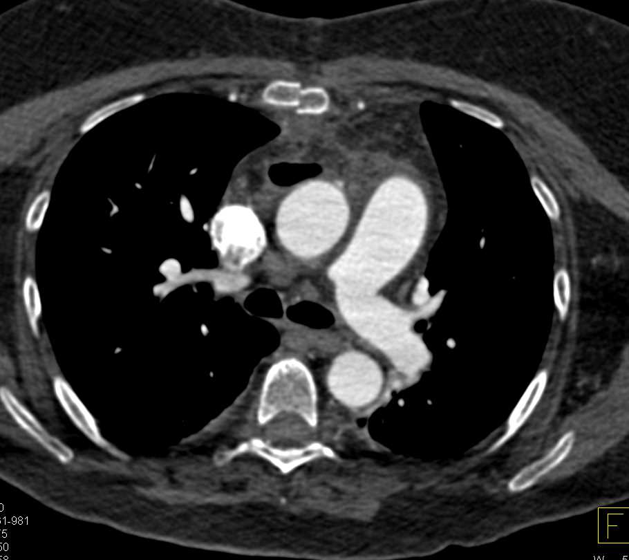 Post Op Median Sternotomy - CTisus CT Scan