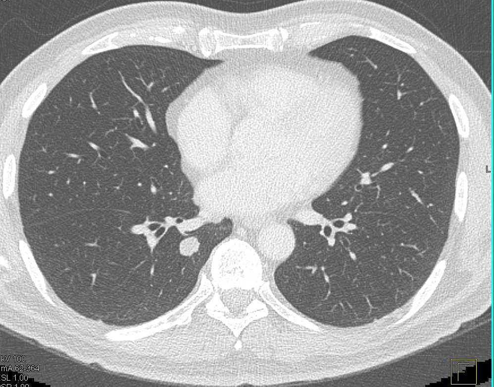 Lung Metastases from Colon Cancer - CTisus CT Scan