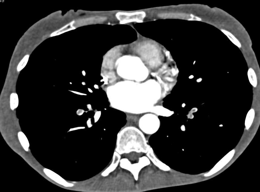 Multiple Pulmonary Emboli - CTisus CT Scan